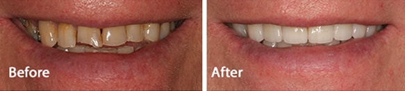 replacing missing teeth before and after