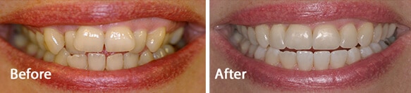 Teeth transformation using Invisalign