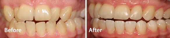 Before and after Invisalign treatment