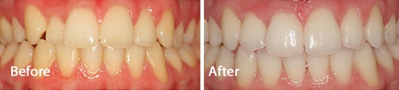 Straight teeth with Invisalign