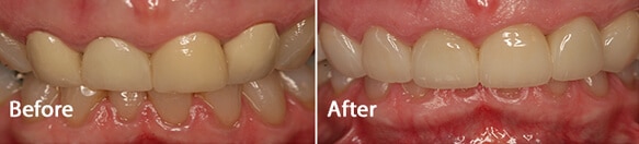 Before and after smile makeover
