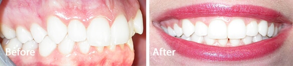white teeth transformation