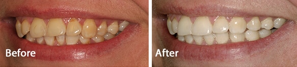 amazing teeth whitening results