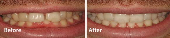 white fillings teeth