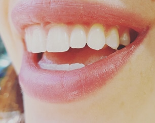 close-up of smiling white teeth
